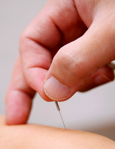 TRT acupuncture